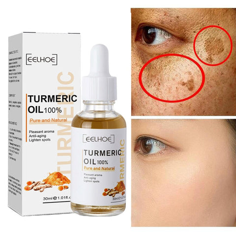 Turmeric Freckle Whitening Serum Curcumin Oil Brighten Fade Dark Spot Removal Pigment Melanin Correcting Beauty Face Skin Care